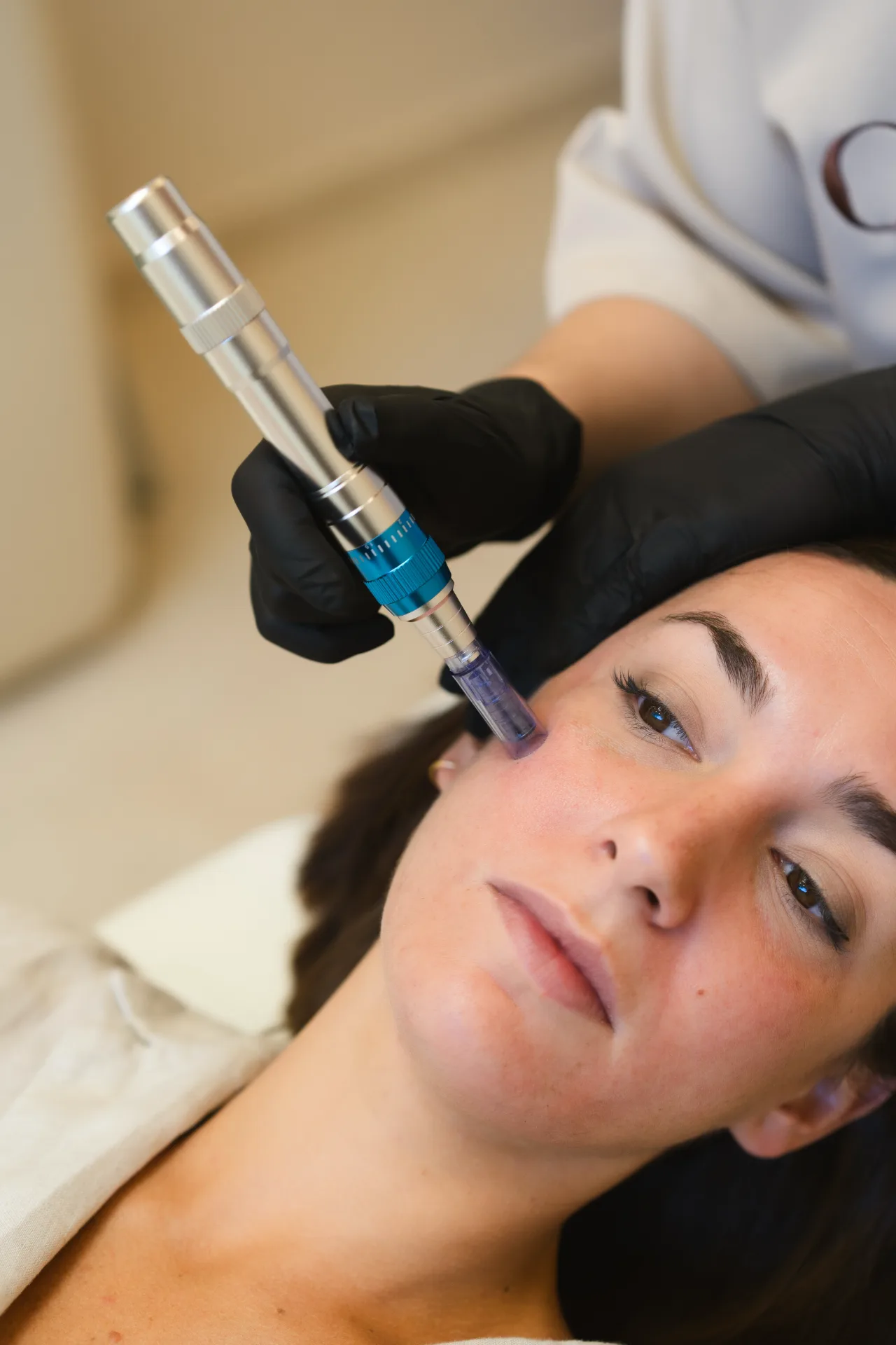 Tratamiento de microagujas facial para rejuvenecimiento de la piel en MOS Granada